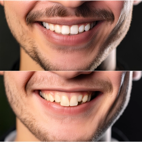 Сложные случаи восстановления зубного ряда